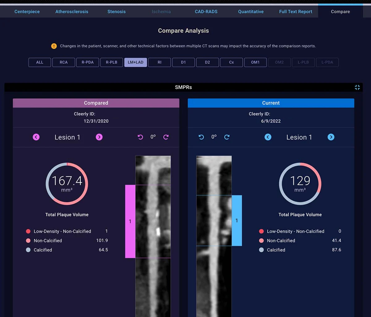 Cleerly COMPARE Coronary Plaque Analysis Cleerly COMPARE Coronary Plaque Analysis